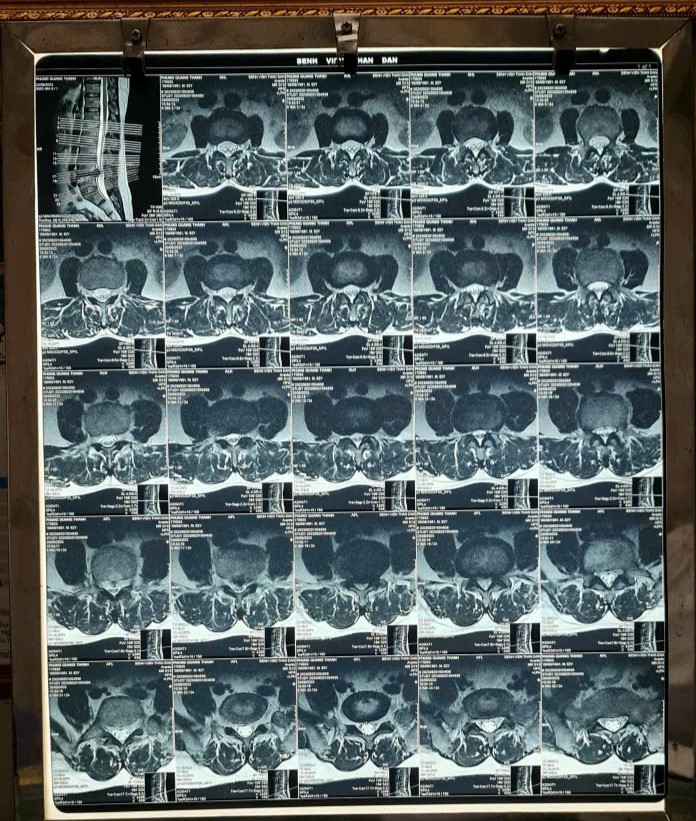 Thoát vị đĩa đệm L4-5